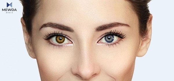 رەنگی چاوەکان بۆ جیاوازە؛ پزیشکێک هۆکارەکەی ئاشکرا دەکات