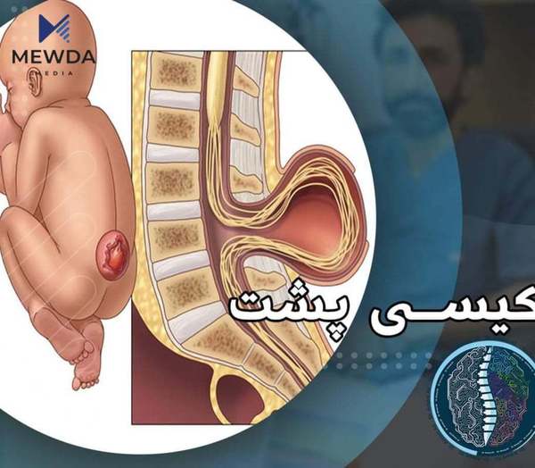 رێنمایی تەندروستی لەبارەی کیسی پشتەوە