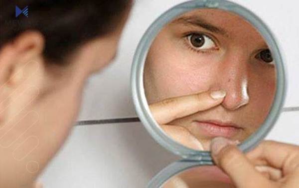 چەند رێگەیەك بۆ لابردنی خاڵە رەشەكانی لووت و چەناگە