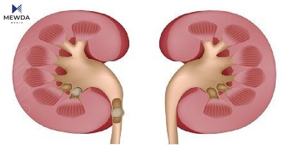 بەم خواردنە گورچیلەت لە بەرد بپارێزە