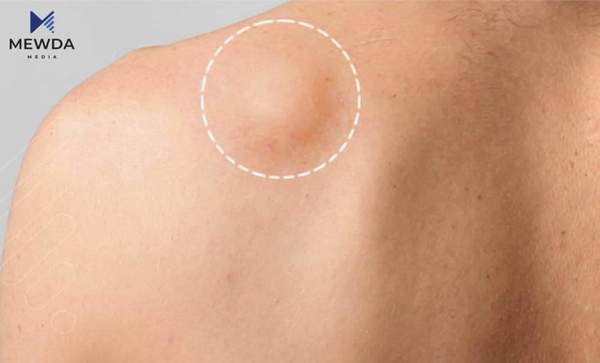 بۆ لە گرێی چەوری نەترسین؟