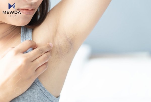 رەشی دوای لابردنی مووی زیادەی ژێرباڵت مەهێڵە