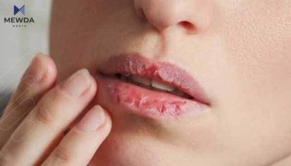 چی وادەکات دەم و لێوەکان وشکببنەوە؟