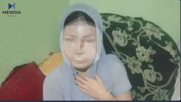 كوڕێك بە ئاوی گەرم دەموچاوی كچێكی سووتاند