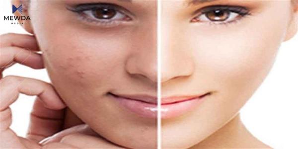 هۆکار و چارەسەرەکانی پەڵەی پێست