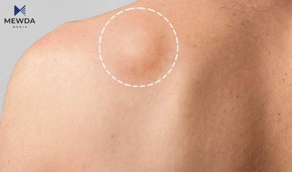 پزیشکی مەودا؛ هۆکار و چارەسەرەکانی گرێی چەوری چین؟