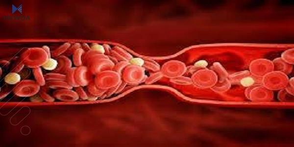 پزیشکی مەودا؛ هۆکار و چارەسەرەکانی تووشبن بە نەخۆشیی خوێن مەین چین؟
