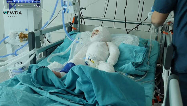 لەمانگێكدا 145 نەشتەرگەری لەنەخۆشخانەی سووتاویی سلێمانى ئەنجامدراوە